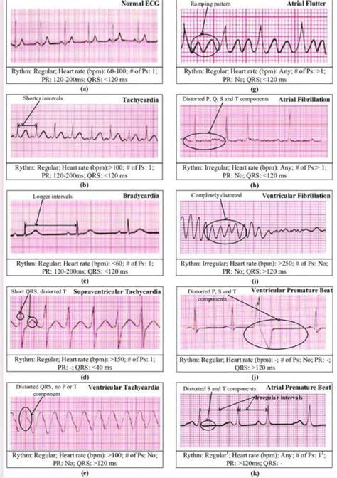 abnormal ekg readings|8 Reasons Why Your EKG Reading Could be Abnormal.